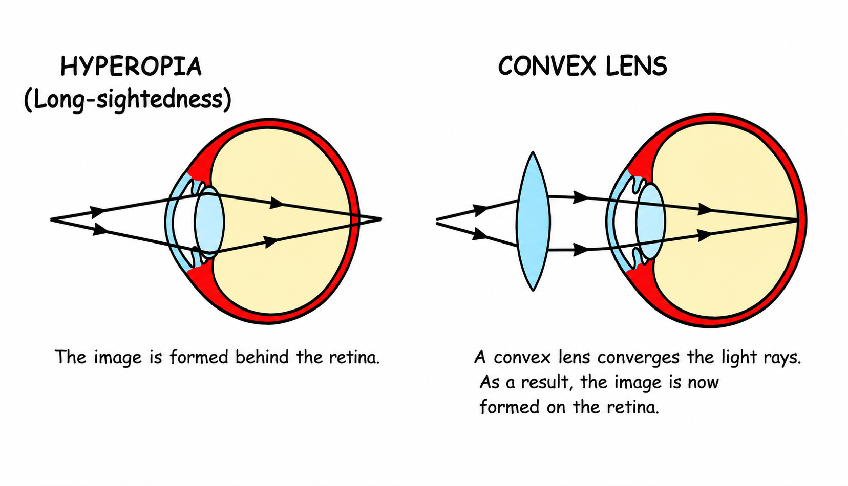 Fig 9.16: Long-sightedness (Hyperopia) and its correction